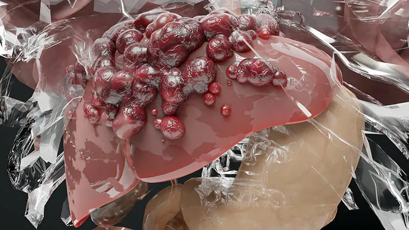HIV raises liver fibrosis risk in women with fatty liver disease