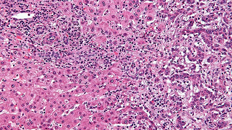 FDA approves lirafugratinib (Lyrfigtu) for FGFR2-mutated bile duct cancer