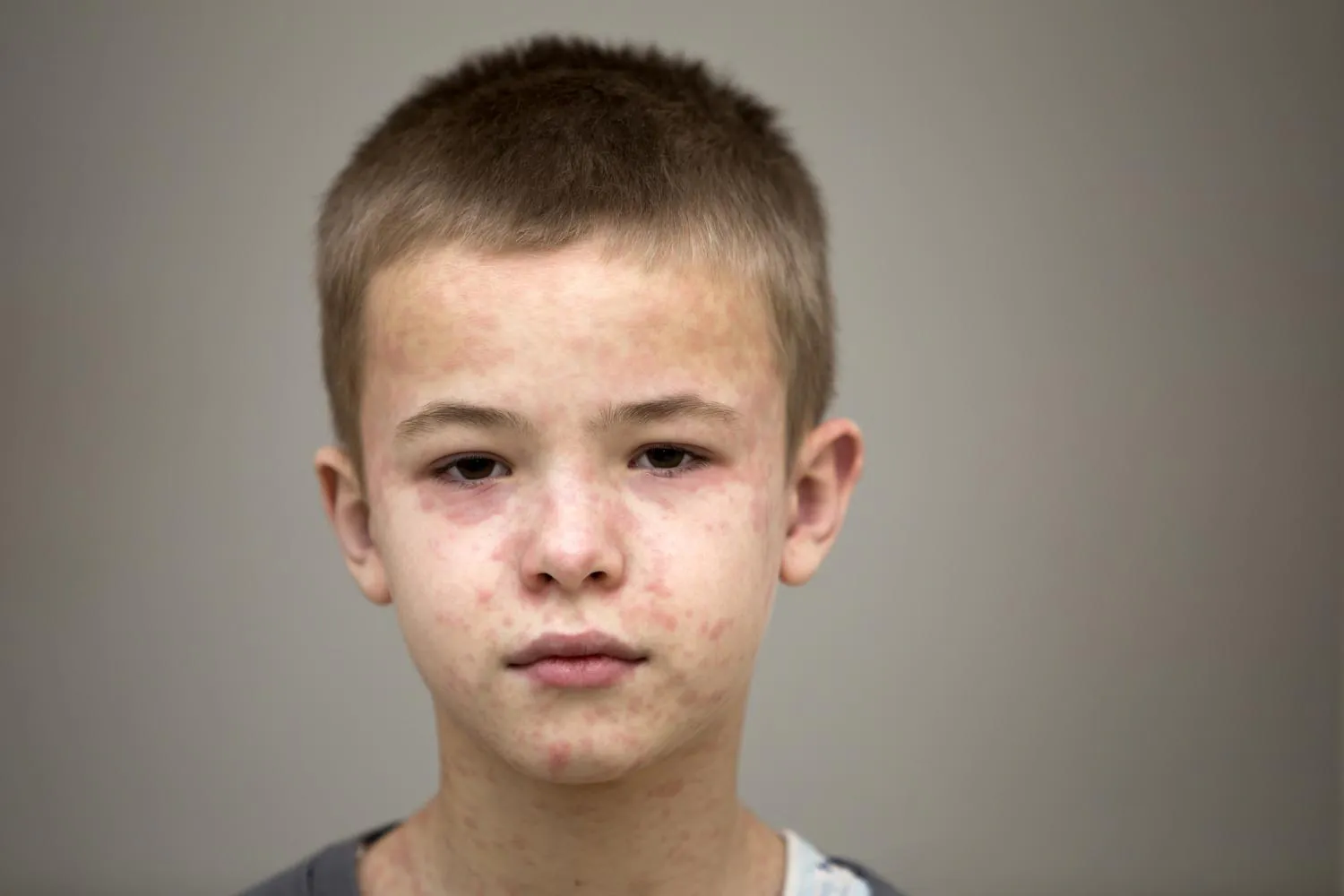 Pennsylvania's measles outbreak surpasses 835 cases amid CDC death-count dispute