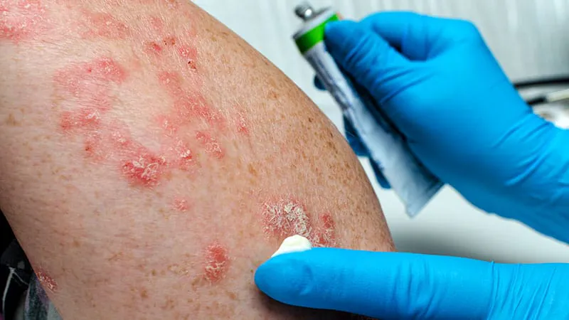 New psoriasis drug shows durable skin clearance six months after last dose
