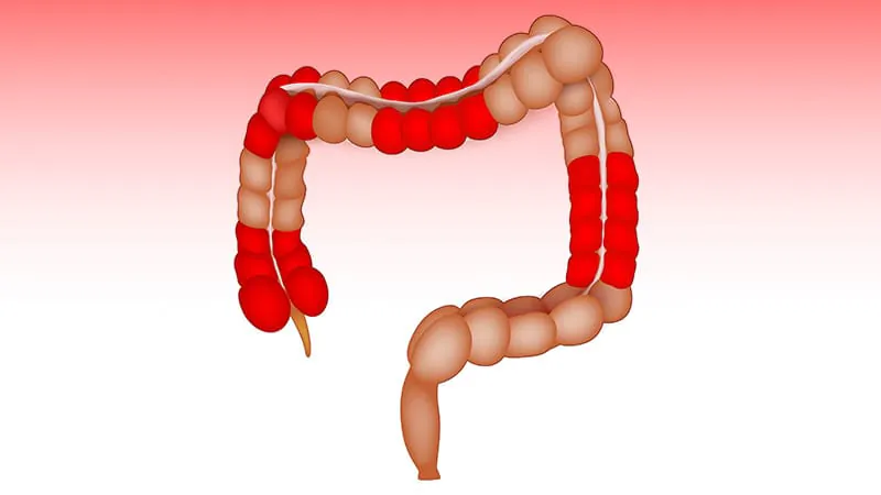 Steroids + IBD therapy = serious infection risk, and the numbers are striking