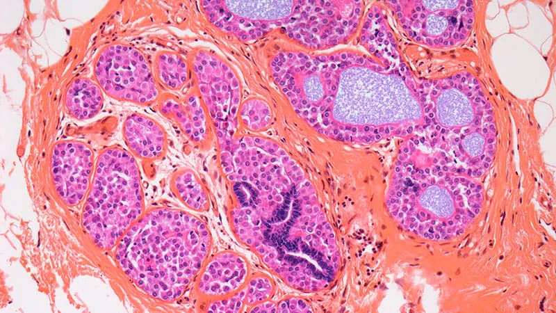 Narrow lumpectomy margins are safe for most DCIS patients, large study finds
