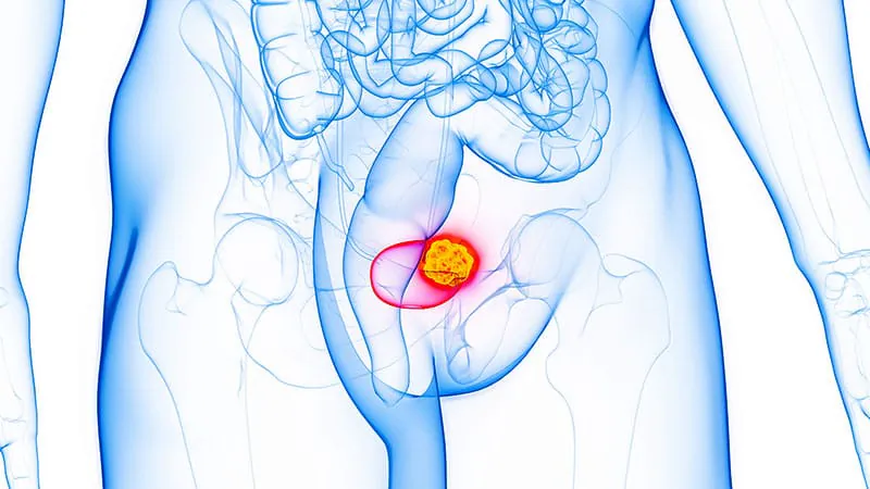 ASTRO's first bladder cancer radiation guidelines expand treatment options beyond surgery