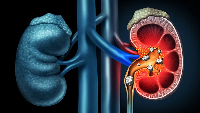 The 95-minute rule: Why kidney stone surgery duration matters for older patients