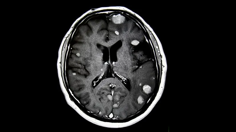 Fractionated radiation after brain metastasis surgery outperforms single-dose treatment in landmark trial
