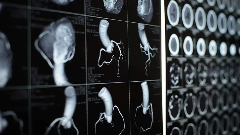 CT-derived blood flow measure predicts heart attack and cardiovascular death beyond standard risk factors