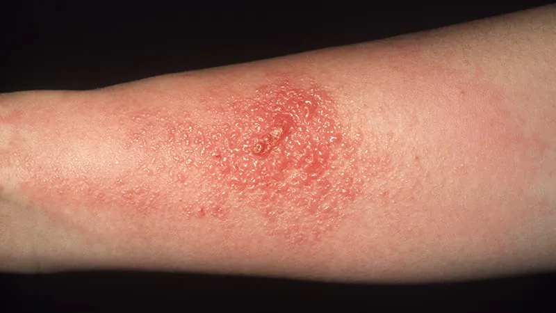 "PPD-free" hair dye labels are misleading millions of allergy sufferers