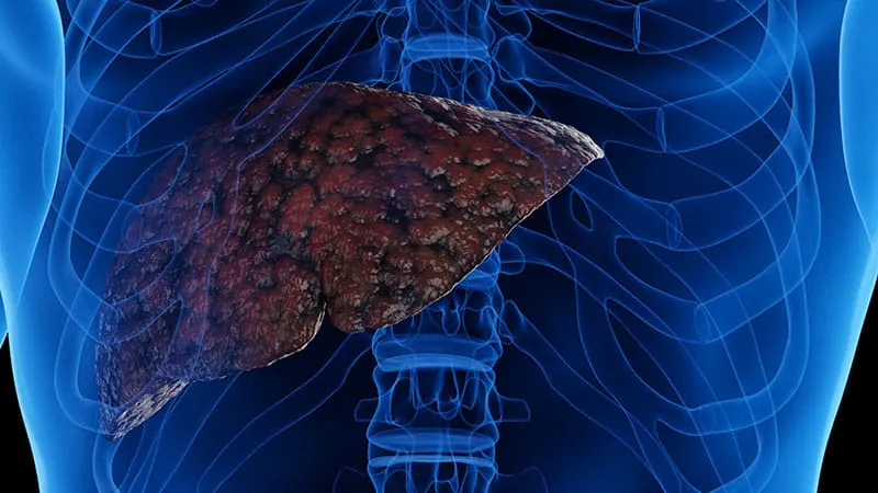 A smarter way to predict liver cancer risk in cirrhosis patients