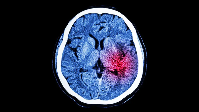 For young stroke survivors, bleeding risk may outpace the risk of another stroke