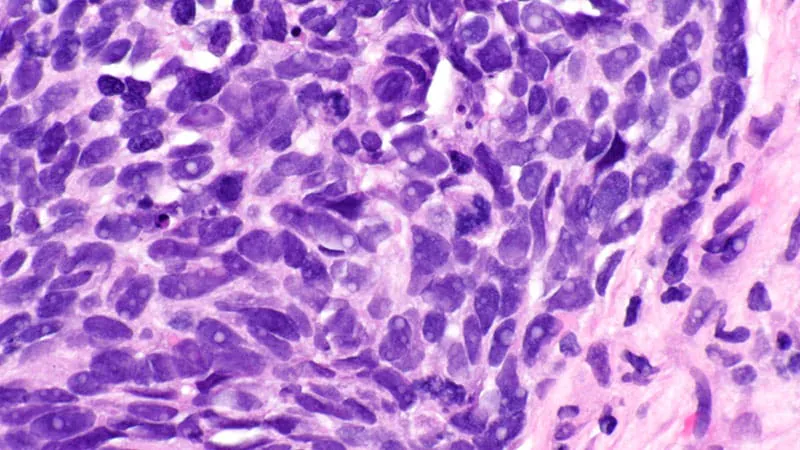 Adding immunotherapy to radiation therapy boosts survival in early-stage lung cancer