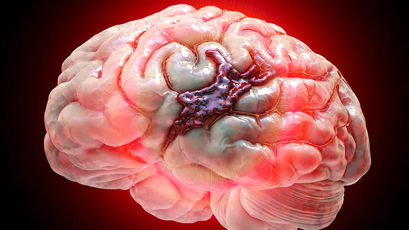 Timing matters: Evening and nighttime brain bleeds lead to worse outcomes