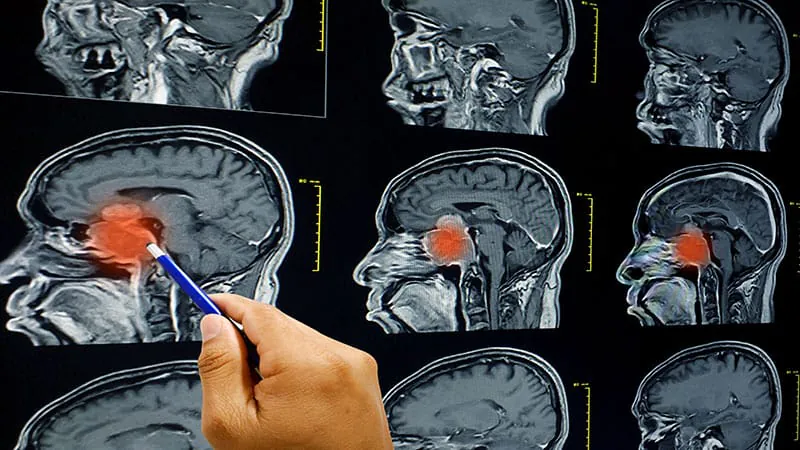 Targeted brain radiation rivals whole-brain therapy in small cell lung cancer