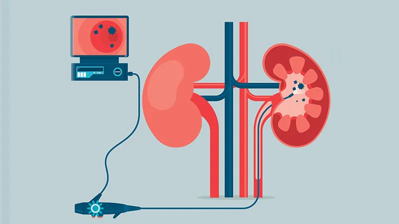 CT scans and urine tests can't replace scope procedures for upper tract bladder cancer surveillance