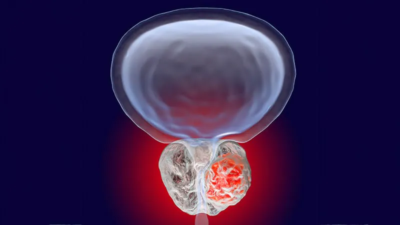 Radiation beats surgery on quality of life for prostate cancer — without sacrificing cancer control