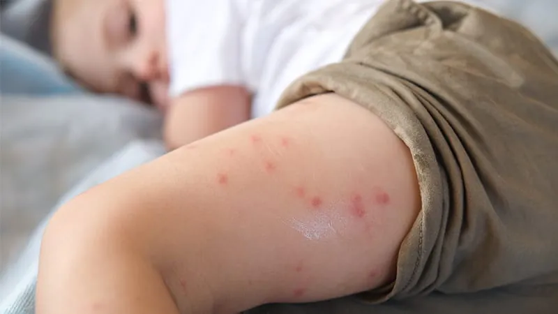 Kids with rare skin disorders face early growth setbacks — and genetics determines who catches up
