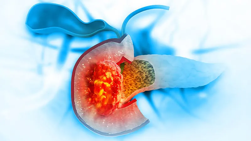 SBRT vs. chemoradiation before pancreatic cancer surgery: Better quality of life, but a survival trade-off?
