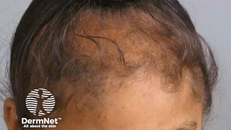 Irish dancing wigs linked to hair loss in young girls