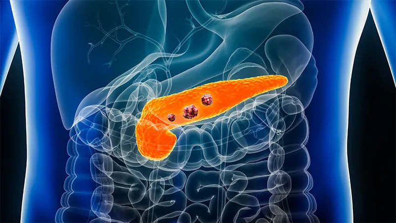 Daraxonrasib earns FDA approval for metastatic pancreatic cancer, nearly doubling survival
