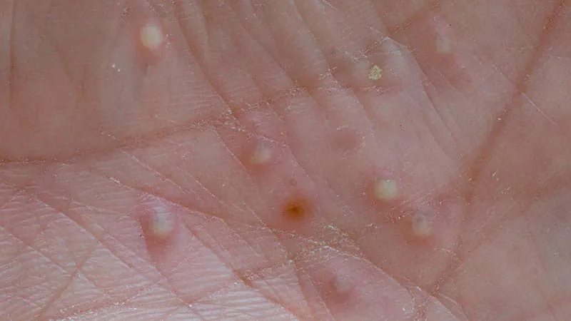 Generalised pustular psoriasis is becoming more common — and far more deadly than most realize