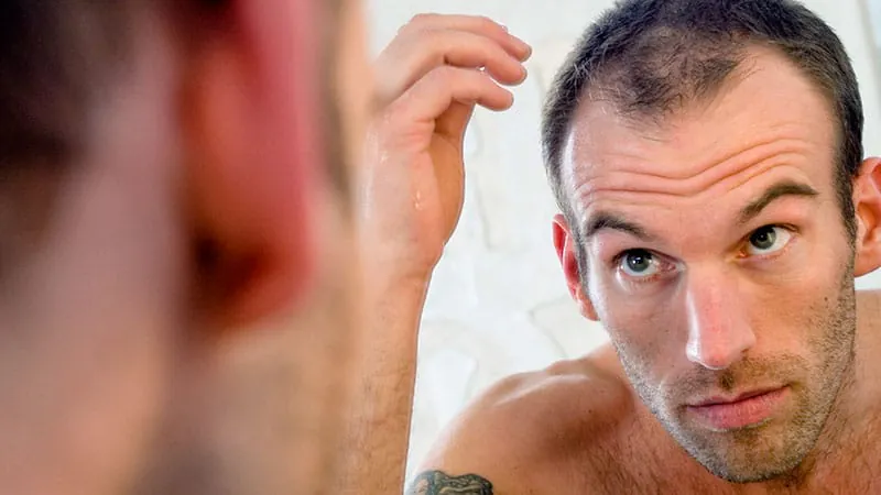 Early hair loss in young adults may signal deeper metabolic trouble