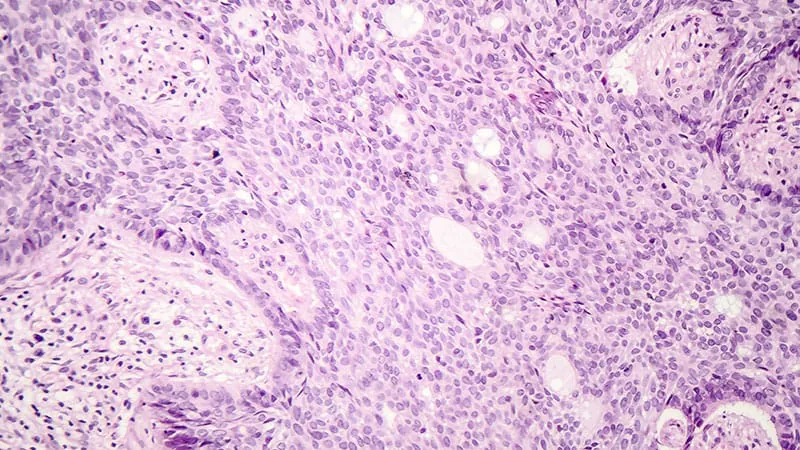 RNA immunotherapy offers a nonsurgical shot at clearing basal cell carcinoma