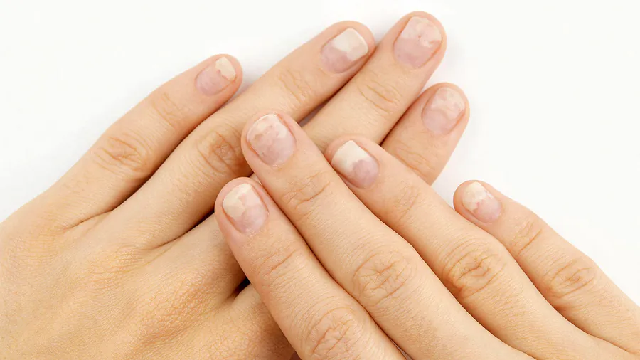 GLP-1 drugs linked to nail disorders in large new study