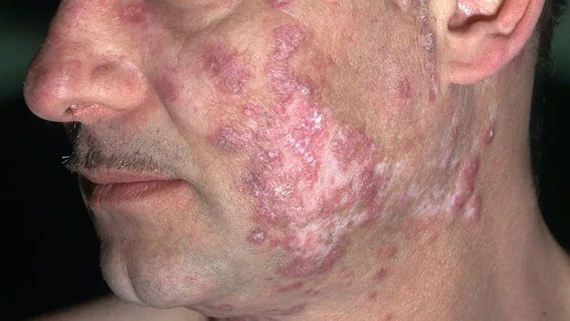 Daxdilimab shows strong results in phase 2 trial for discoid lupus