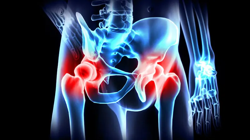 Ultra-low radiation dose offers effective bone pain relief in multiple myeloma