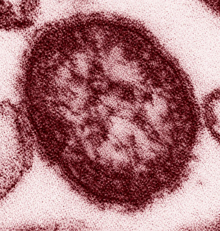 US measles crisis deepens: nearly 4,000 cases and counting