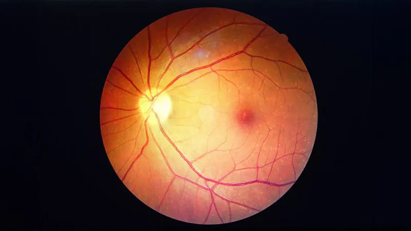 Eye damage from diabetes may start earlier than we thought
