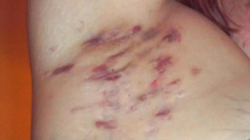 Three new drug trials signal a treatment revolution for hidradenitis suppurativa