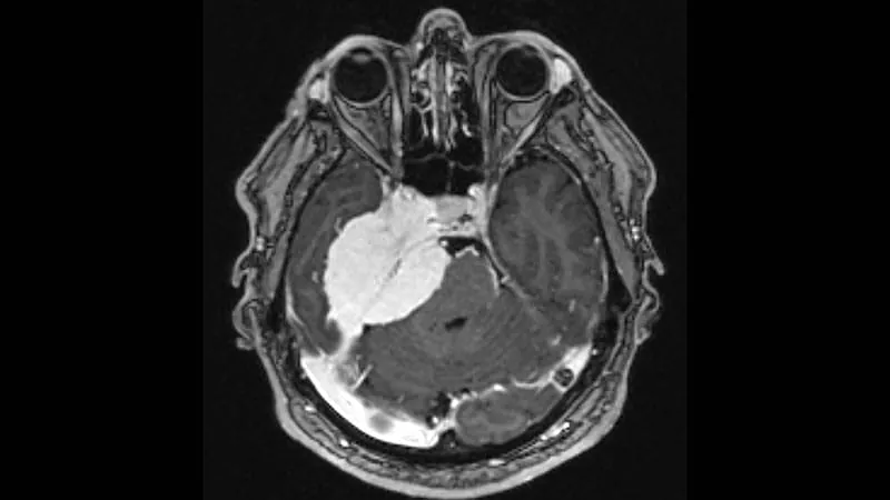 Adjuvant radiotherapy cuts meningioma recurrence risk in half after complete surgical removal