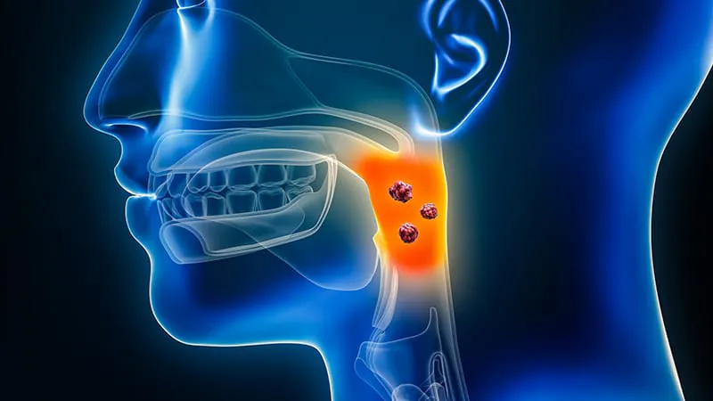Turning down the dial: lower radiation dose eases side effects in HPV-related throat cancer