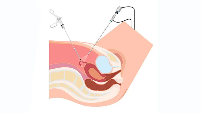Two fibroid surgeries deliver lasting relief — and neither clearly wins at 2 years