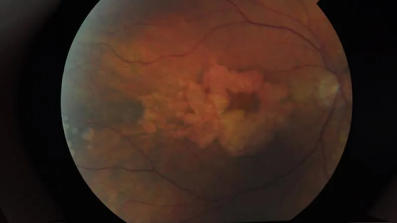 Start sooner, save more: 5-year data back early pegcetacoplan use in geographic atrophy