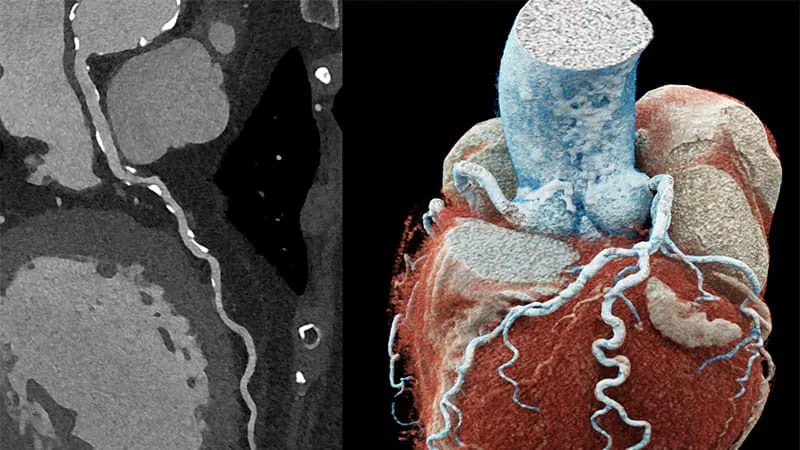 Photon-counting CT is reshaping cardiac imaging — and may cut unnecessary cath lab visits