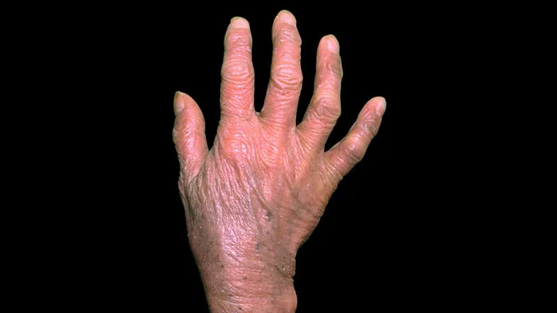 Real-world data reveals best treatment sequences for rare skin lymphomas