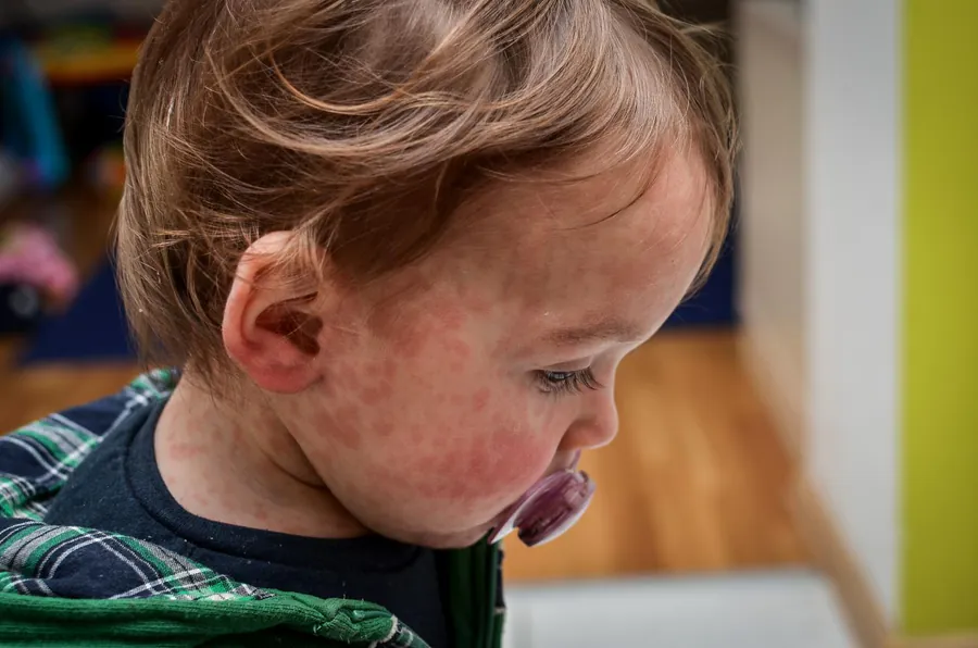 Pennsylvania crosses 1,000 measles cases as US outbreak hits historic levels