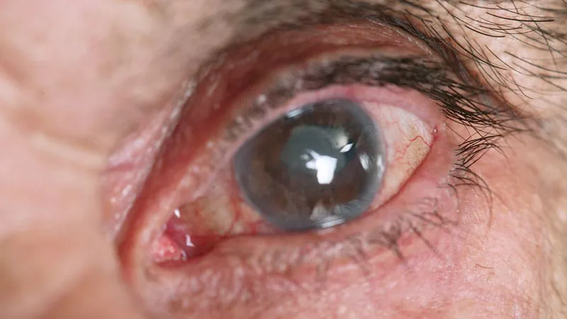 Dupilumab's eye side effects don't fade with time, study warns