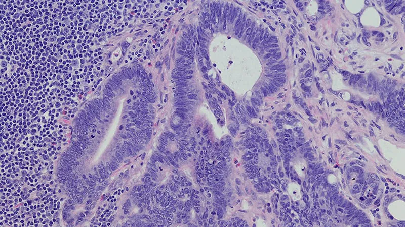 Colorectal cancer in kids and teens: late diagnoses, grim outcomes