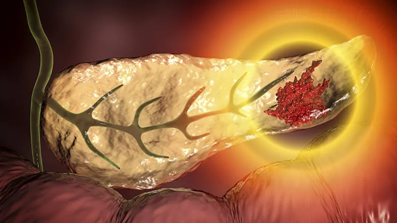 AI-powered CT scan tool could catch pancreatic cancer earlier
