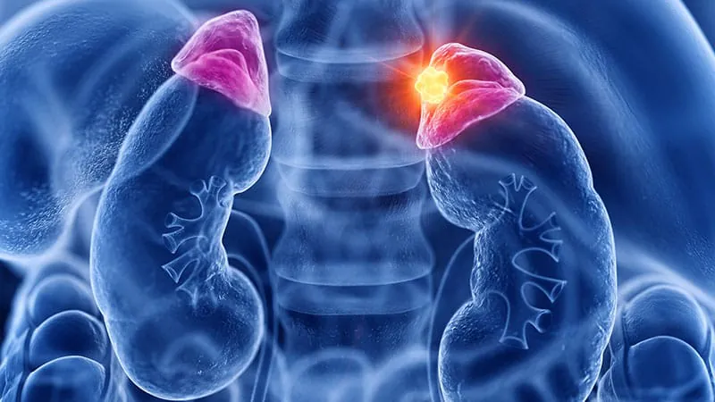 Living near industrial pollution cuts survival in adrenal cancer patients