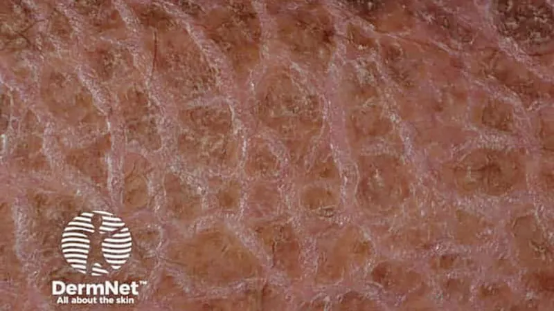 Rare skin disorder linked to significantly higher rates of allergies and asthma