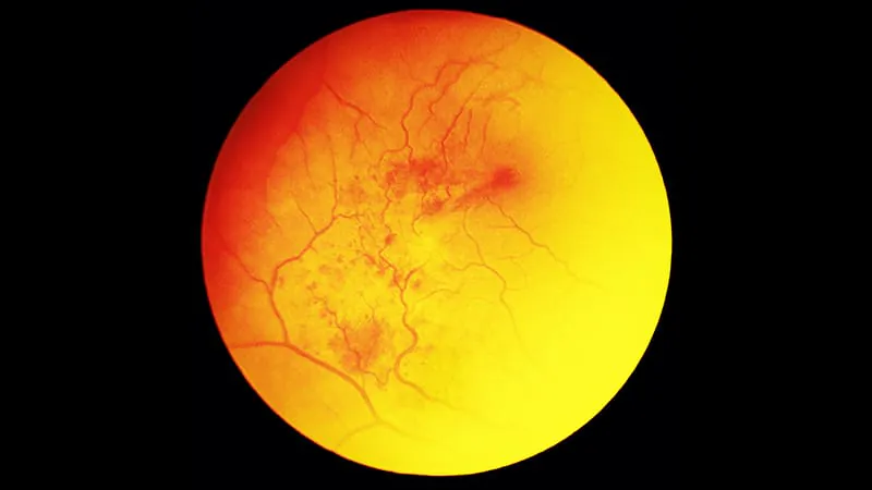 GLP-1 drugs and rare "eye stroke" risk: Should US labels carry a warning?
