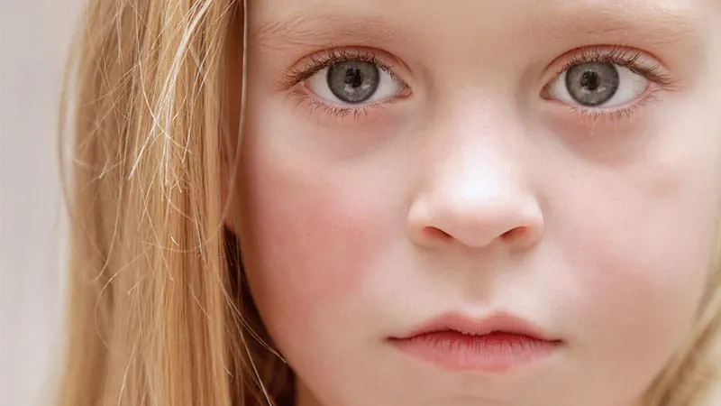 Telehealth sun-safety program changes kids' behavior but doesn't cut sunburns