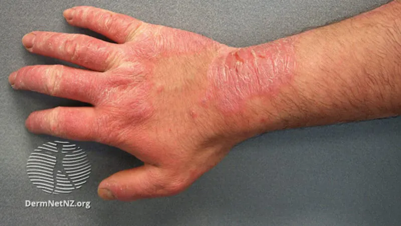 Busting myths about contact dermatitis: What patients (and doctors) get wrong