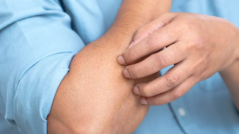 FDA approves remibrutinib as first-ever treatment for symptomatic dermographism