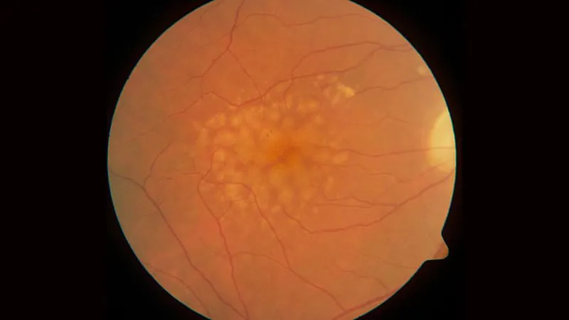 Your patient's drusen type may predict atrophy risk — but won't change their treatment