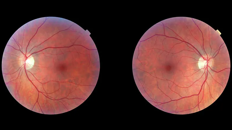 Switching to faricimab offers lasting benefits for hard-to-treat macular degeneration