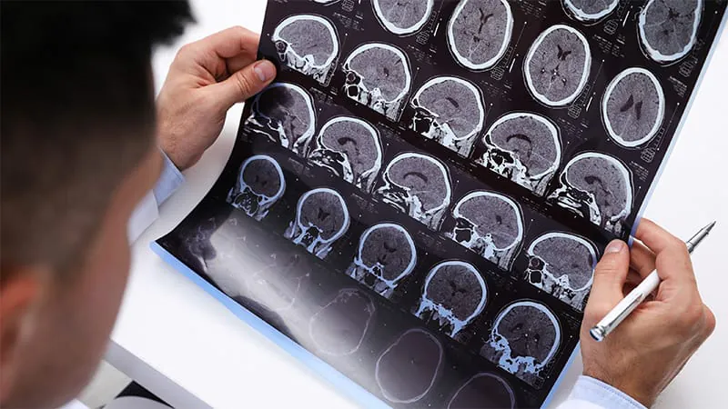 Type 1 diabetes nearly doubles the risk of MS and other demyelinating diseases